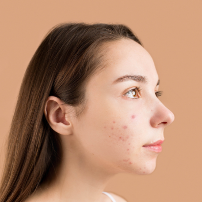 Banish Acne Scars With IPL Therapy